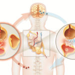 What is Neuropathic Pain and How to Live With Nerve Pain ?