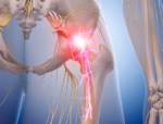 Neuropathic Pain