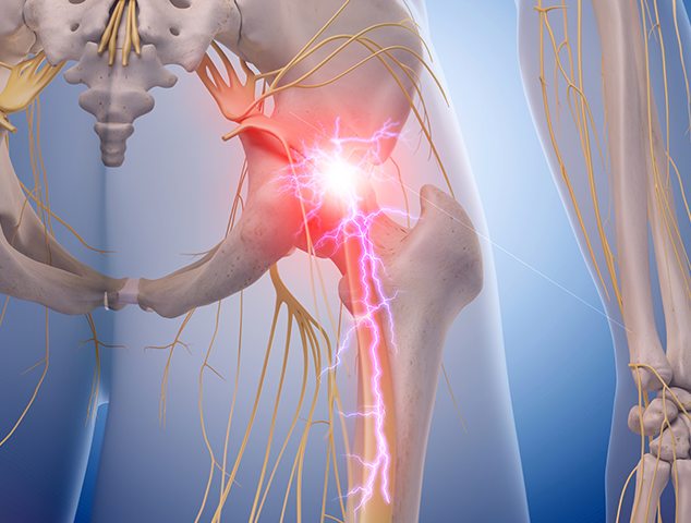 Neuropathic Pain ( Nerve Pain )