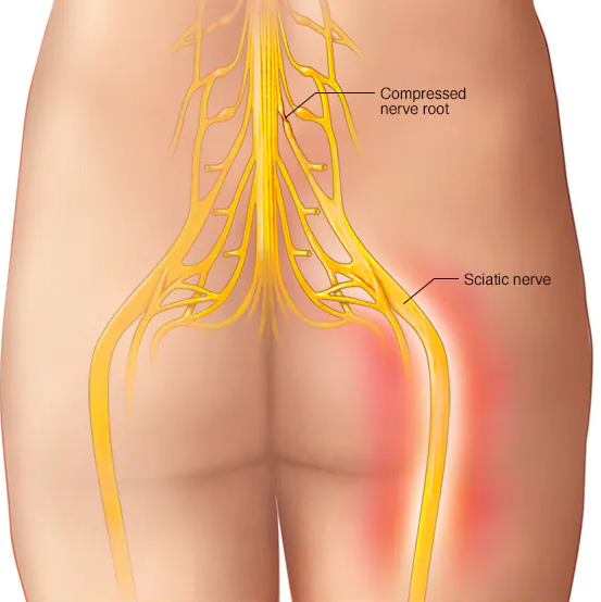 Sciatica