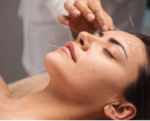 Is Acupuncture Effective for Migraines?