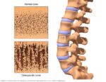 What Are the Causes of Osteoarthritis ?