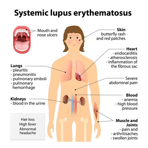 Image result for Lupus - site: .gov