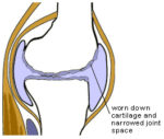 Diet For Arthritis