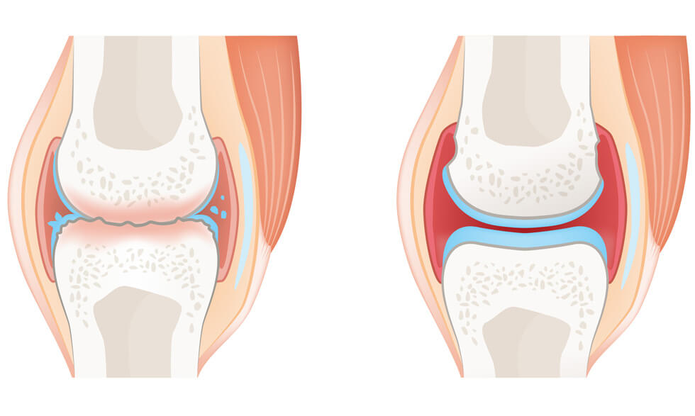 Rheumatoid arthritis or osteoarthritis?