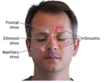 Sinus Headache Remedies