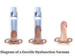 Erectile Dysfunction