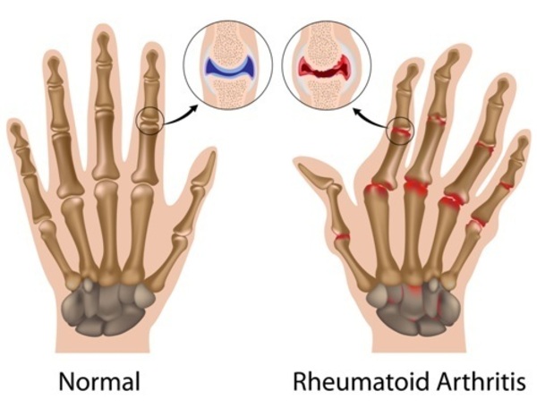 rheumatoid arthritis