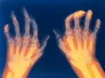 Inflammatory Arthritis and Fibromyalgia, What is The Difference ?