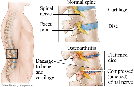 Osteoarthritis