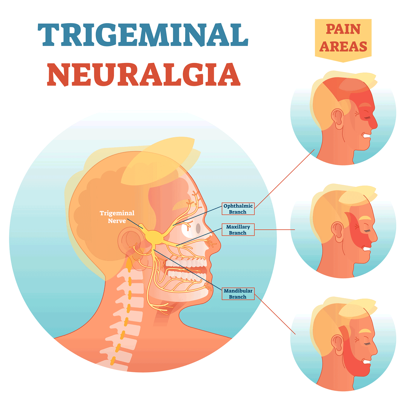 Diagram of the three different branches of the trigeminal nerve: the ophthalmic branch runs near the eye and leads to pain across the top half of the face and forehead; the maxillary branch runs across the nose and causes pain up cheeks and toward the temple; the mandibular branch starts near the ear and causes pain down the jaw.