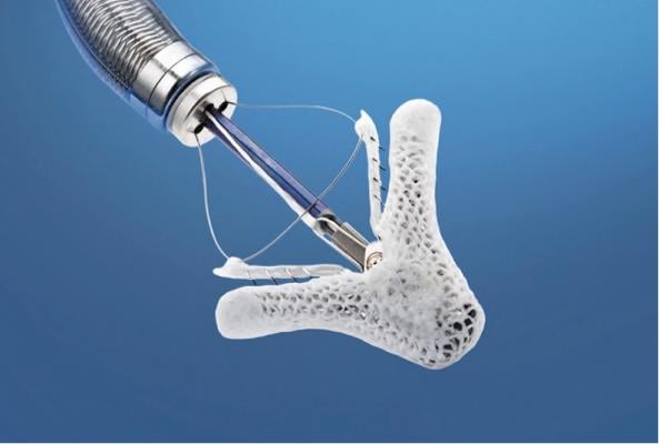 FDA Advisory Committee Supports MitraClip for Patients With Significant Mitral Regurgitation Who Are Too High Risk for Surgery