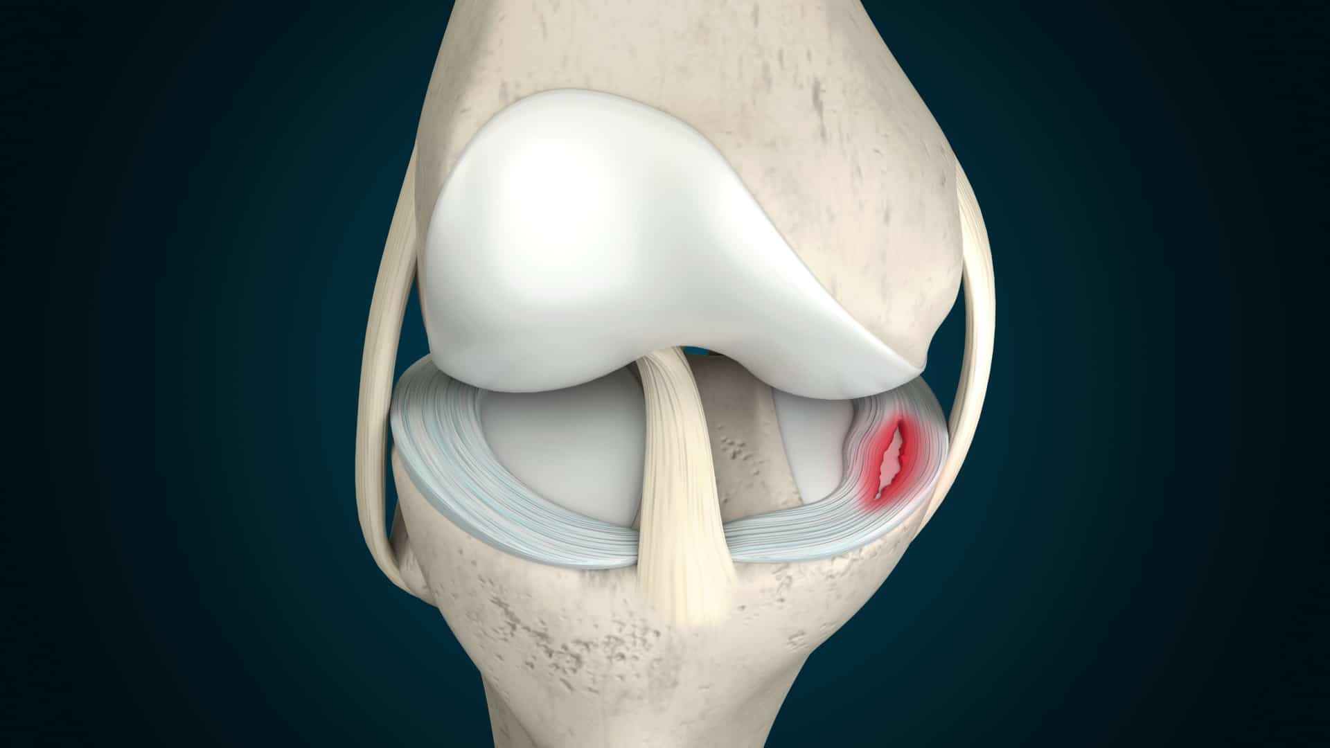 meniscus-tear