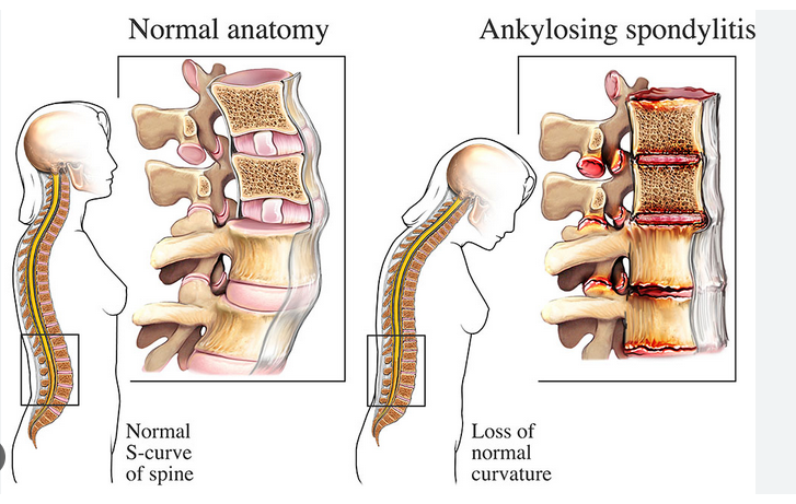 Ankylosing Spondylitis