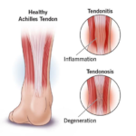 Tendonitis