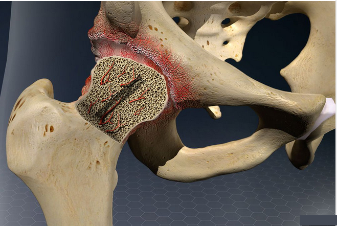 aseptic necrosis