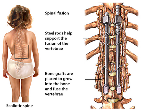 spinal fusion surgery